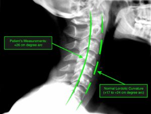 normal neck curvature x-ray image