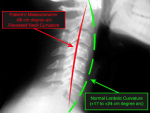 x-ray showing reverse neck curvature