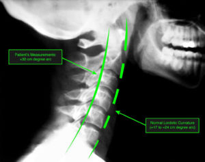 x-ray of normal neck curvature