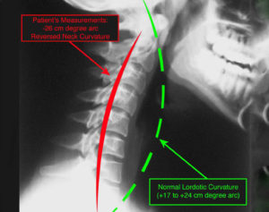 reverse neck curvature x-ray of a standing patient