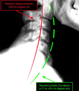x-ray when a neck is out of range
