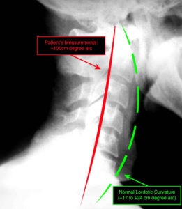 x-ray showing neck out of range