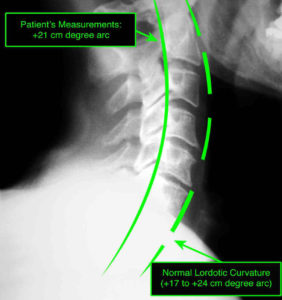 normal neck curvature x-ray