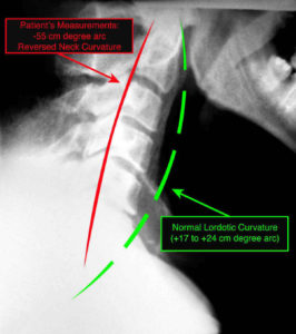 x-ray showing patient's reverse neck curvature