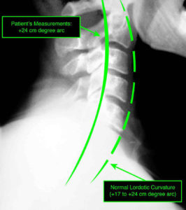 x-ray image of a patient's normal neck curvature