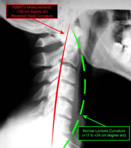 reverse neck curvature x-ray