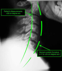 x-ray showing patient's normal neck curvature