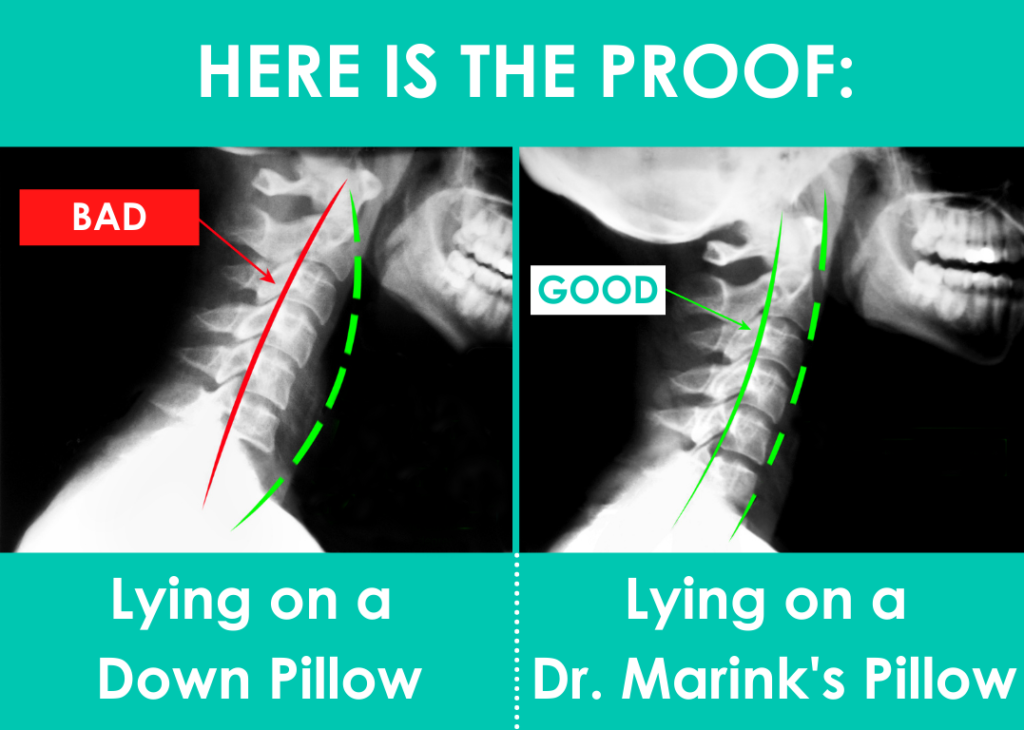 x-ray comparison of lying on a down pillow and on a Dr. Marinks pillow